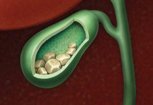 Symptoms and causes of gallbladder stones