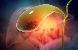 Complication and Prevention Methods for Gallbladder Stones
